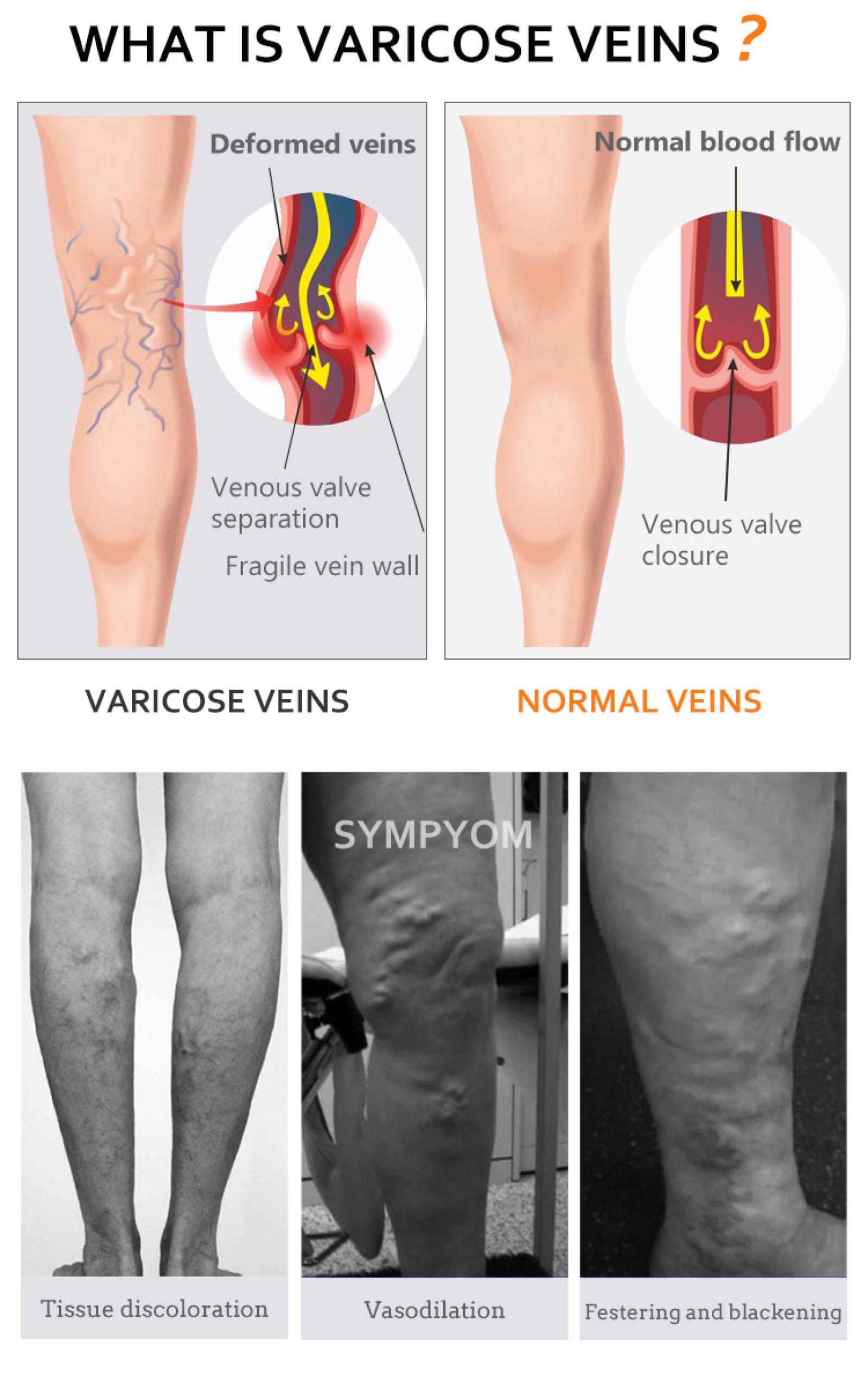 AAGAZA Varicose Compression Stockings 15 to 20 mmHg Varicose Stockings Plus Size Elastic Open Toe Knee High Calf Graduated Pressure 5XL Black(15-21mmHg)/56 (Color : Beige(15-21mmhg), Size : 5XL)
