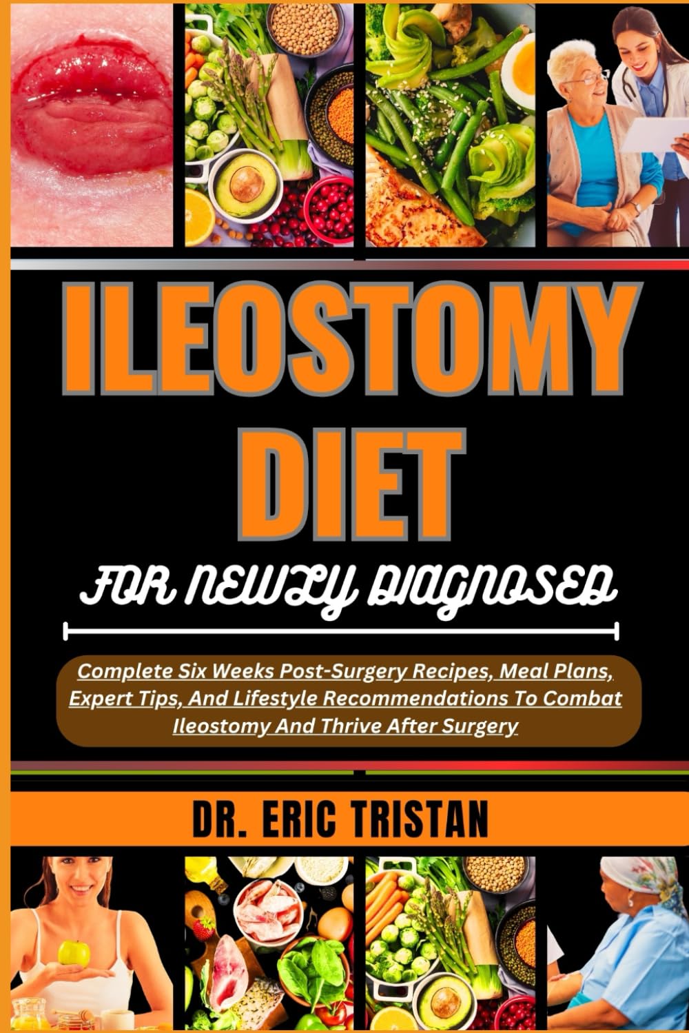 ILEOSTOMY DIET FOR NEWLY DIAGNOSED: Complete Six Weeks Post-Surgery Recipes, Meal Plans, Expert Tips, And Lifestyle Recommendations To Combat Ileostomy And Thrive After Surgery