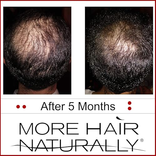 Miniatura 4 de 9: Terapia avanzada de células madre para adelgazar el cabello. ayuda a promover un crecimiento del cabello más saludable, más grueso y más fuerte