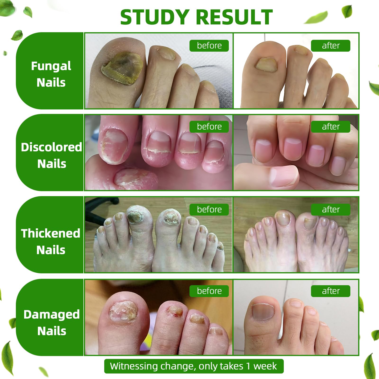 Toenail Fungus Treatment Extra Strength, Brush-On Nail Fungus Treatment with Botanical Oils for Thick, Yellow, Brittle, Discolored & Damaged Toenails 1 Fl Oz (Pack of 1) | — Amazon image 4