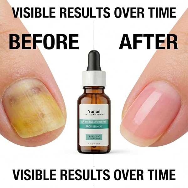 Yanail Siero Unghie 20ml - Coadiuvante per Micosi Unghie Piede e Mani - Formula Rinforzante e Protettiva con Estratti Naturali - Trattamento Riparatore per Unghie Danneggiate e Fragili - 3