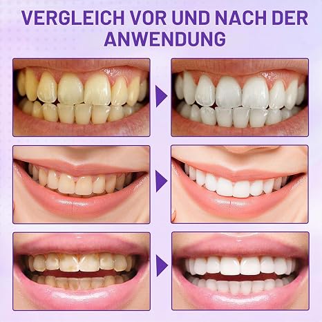 Purple Teeth Whitening Strips Pack of 14 Teeth Bleaching Strips for Whiter