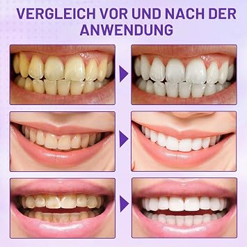 Purple Teeth Whitening Strips Pack of 14 Teeth Bleaching Strips for Whiter