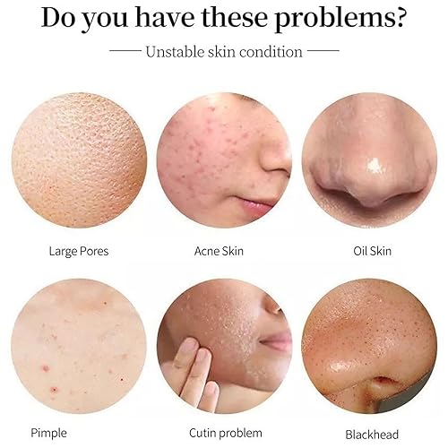 Miniatura 2 de ARCHIDATE Suero de ácido salicílico al 5% para el acné, limpia profundamente los poros, reduce los puntos negros, controla el aceite, exfoliación