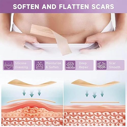 Miniatura 6 de Cinta de silicona para cicatrices, hojas de cicatriz de silicona, cinta de cicatriz para cicatrices quirúrgicas, tiras de silicona para cirugía,