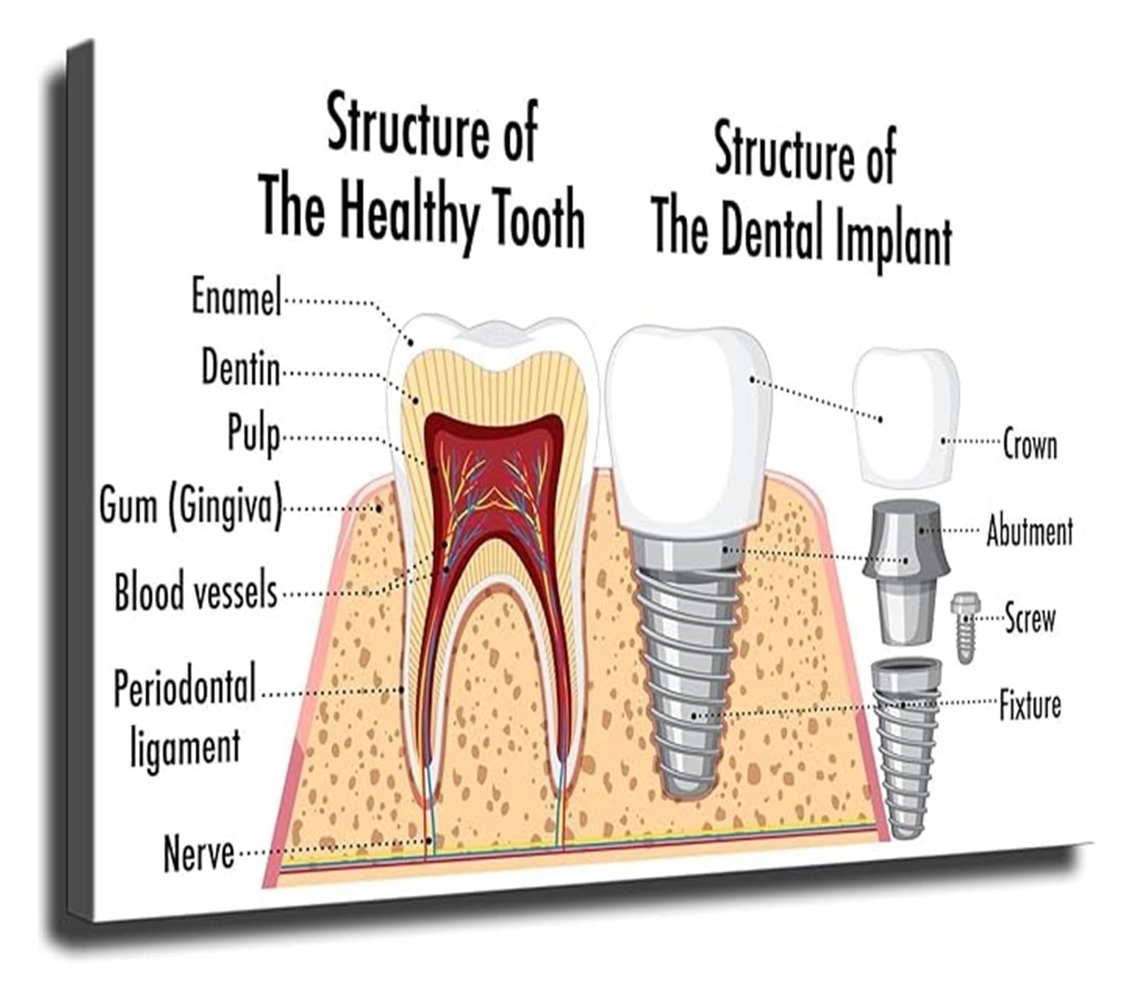XGINERFEX Implant Diagram Anatomy Educational Poster Tooth Structure Chart for Office Clinic Student Reference(Unframed,12x18inch(30x45cm))