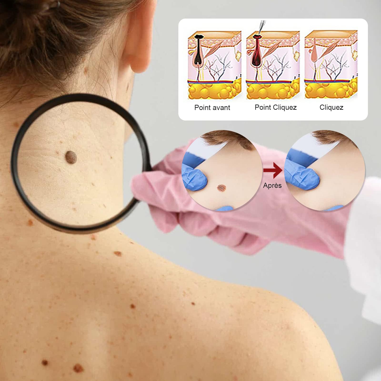 Action Enlèvement Des Acrochordons – Pipette Précision Visage & Corps | Élimination Ciblée des Verrues Plantaires, Vulgaire et Plates | Formule Douce à, Format Voyage(10ml)