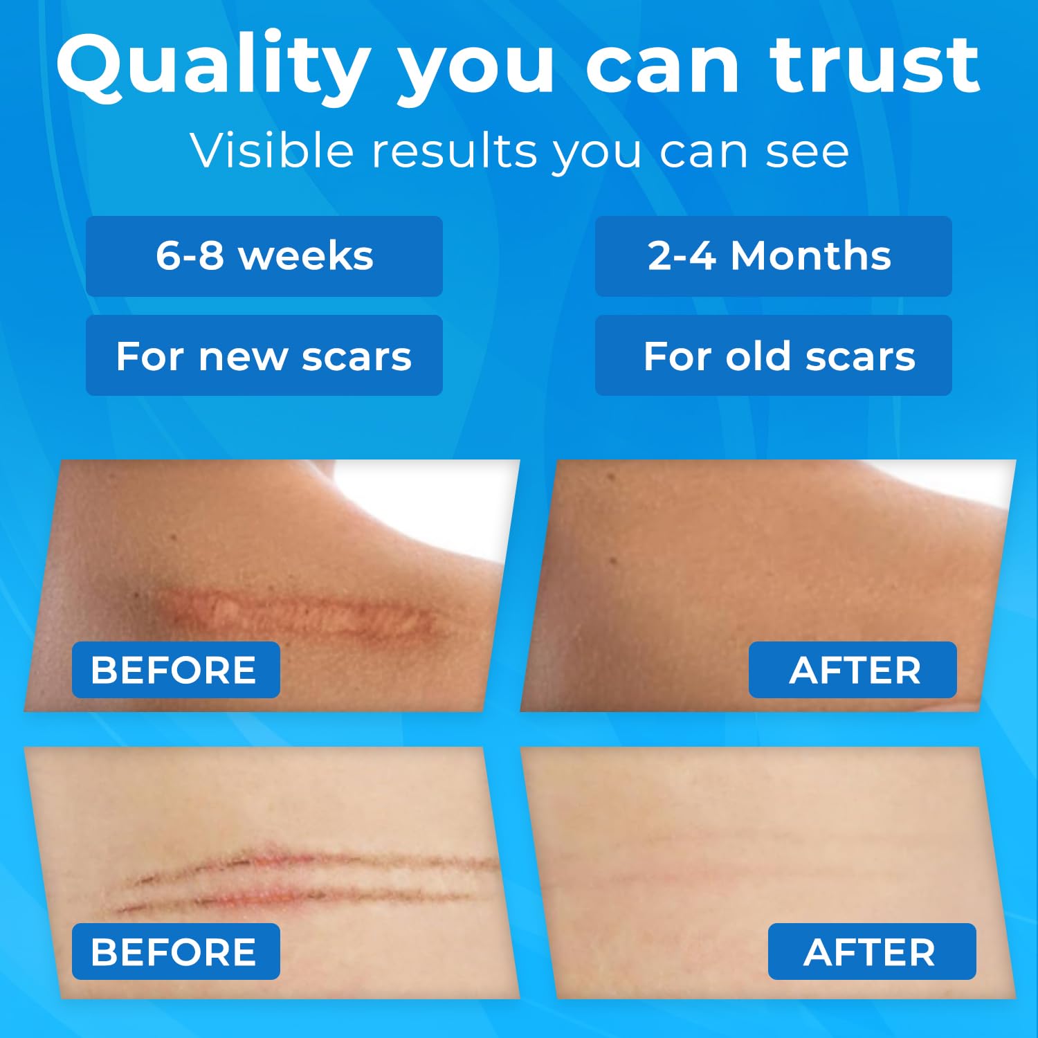 Silicone Scar Sheets Roll (1.6"x158" 4m) - Reusable Waterproof Scar Tape, Strips for C-Section, Surgery, Keloid, Burn & Acne Scars Removal - Image 6