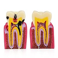 Vista 3 de Ultrassist Modelo de caries dental 6 veces caries dentales Modelo de caries bilateral Comparación bilateral Modelo de patología Dientes