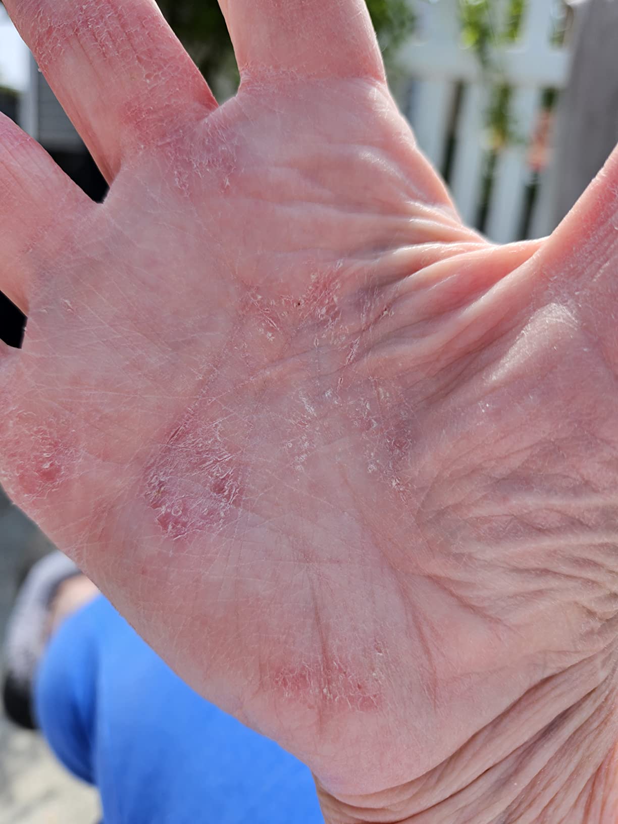 6/mo Finance Clinically Tested DermaCalm SOS Therapy Eczema