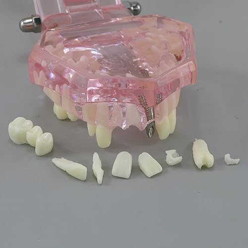 Miniatura 6 de Dental Dental Dental Modelo de Dientes de Restauración de Implantes Puente Demostración Enseñar Estudio Patología Oral Typodont para Enseñar Estudio
