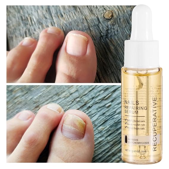 7 Days Nail Growth And Strengthening Serum 20ml Onychomycosis Softening Solution Nails Treatment Oil for Discolored And Damaged Nails
