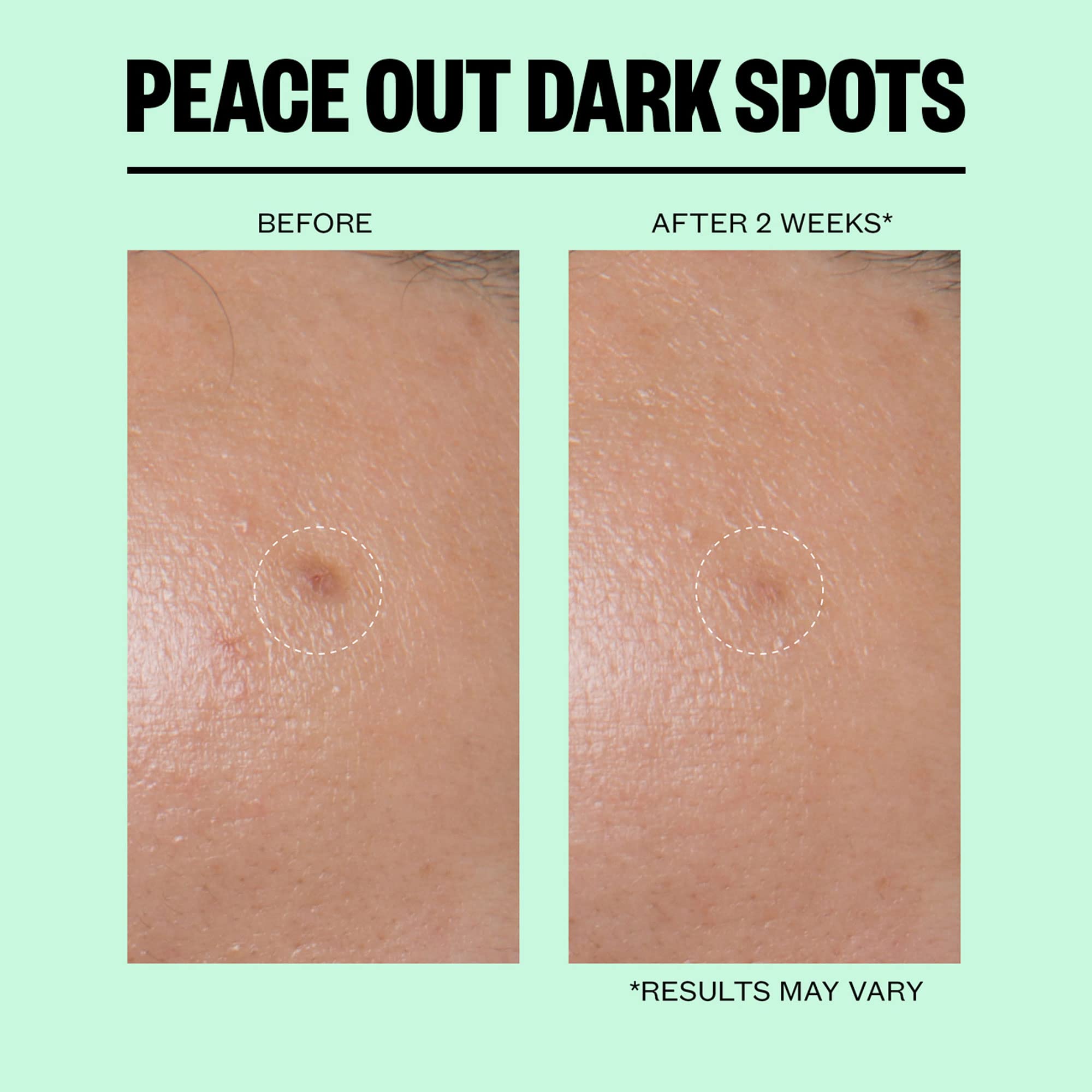 Peace Out Skincare Dark Spots. Dissolving Microneedling Dots to Reduce the Appearance of Dark