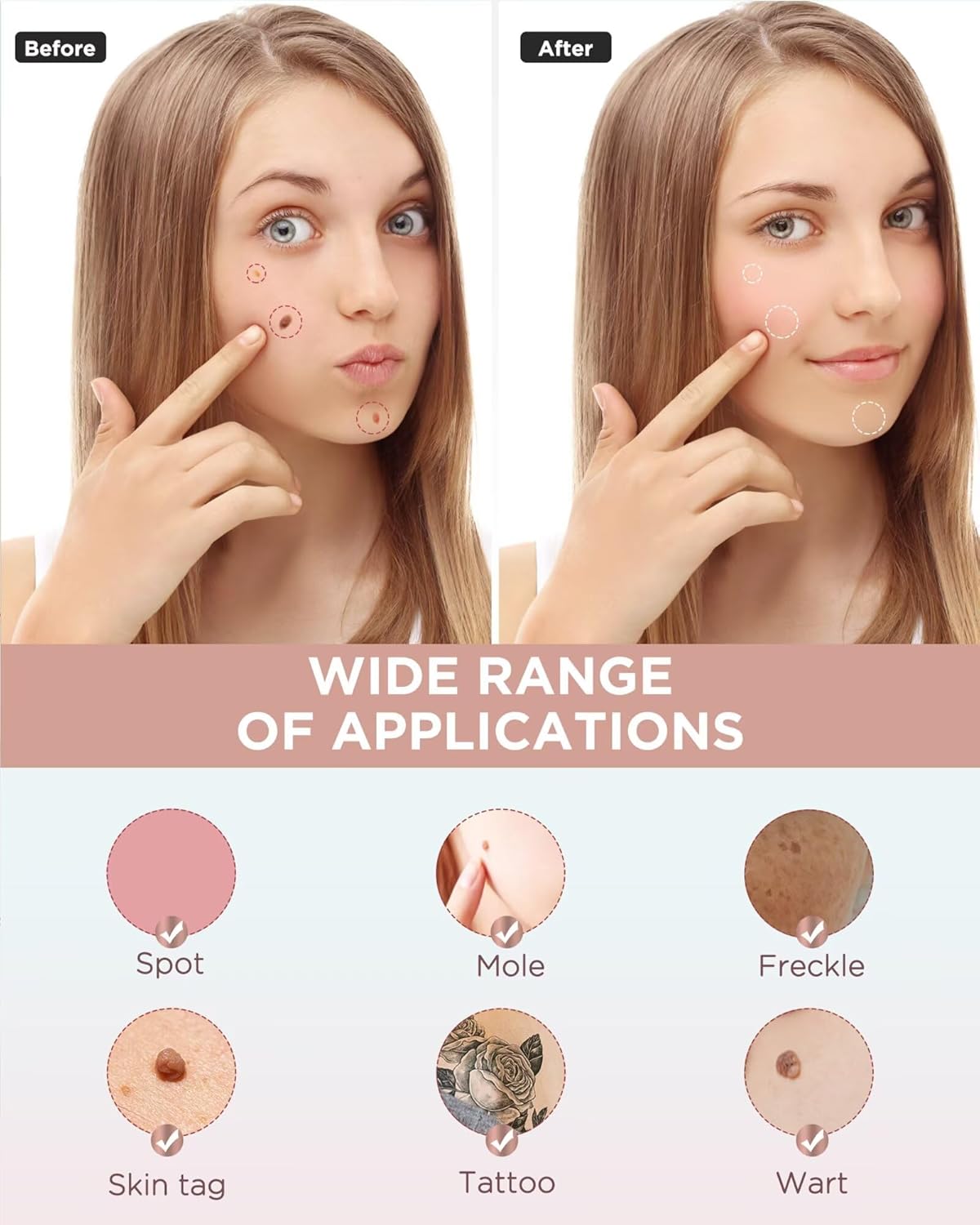 Skin Tag Remover - Skin Tag and Mole Remover for Home Use, Portable Removal Kit for Mole, Wart and Skin Tag for Women and Girls