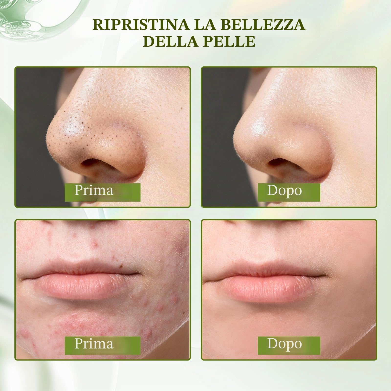 Crema Brufoli Viso, Crema Acne Potentissima, Combatte Efficacemente Acne, Brufoli e Punti Neri, Lenisce Rapidamente Gli Arrossamenti Cutanei, Adatto a Tutti i Tipi di Pelle, Ingredienti Delicati