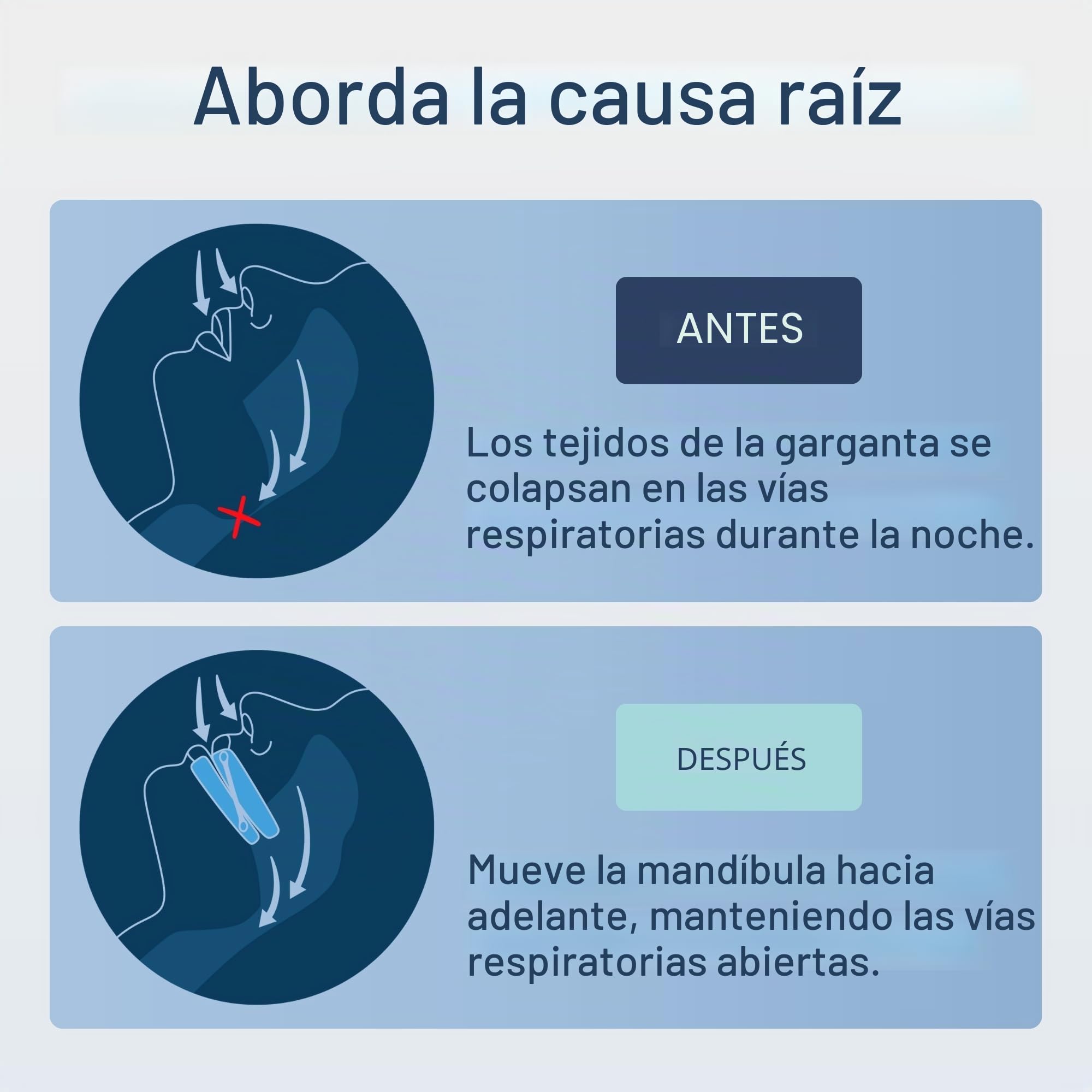 Somnofit-S - Protector bucal antirronquidos de lujo, boquilla antironquidos, 510 (k) aprobado por la FDA, fabricado en Suiza, dispositivo personalizable para detener los ronquidos, reduce los