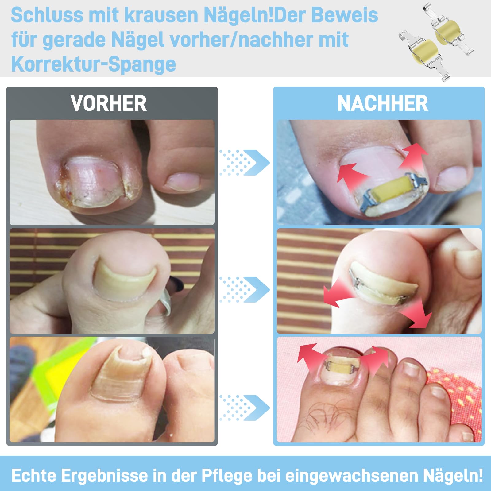 Eingewachsene-Nagel-Korrektor–Einfache Anwendung für zu Hause,sicherer Halt(rutscht nicht ab),kontinuierlicher Zug für schnelle Schmerzlinderung.--21mm bis 23mm Toenail-Länge