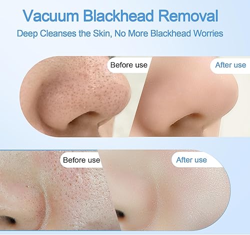 Miniatura 4 de Aspirador removedor de puntos negros con función de calefacción y frío, removedor de cabeza negra para cara y nariz con cámara, removedor de puntos