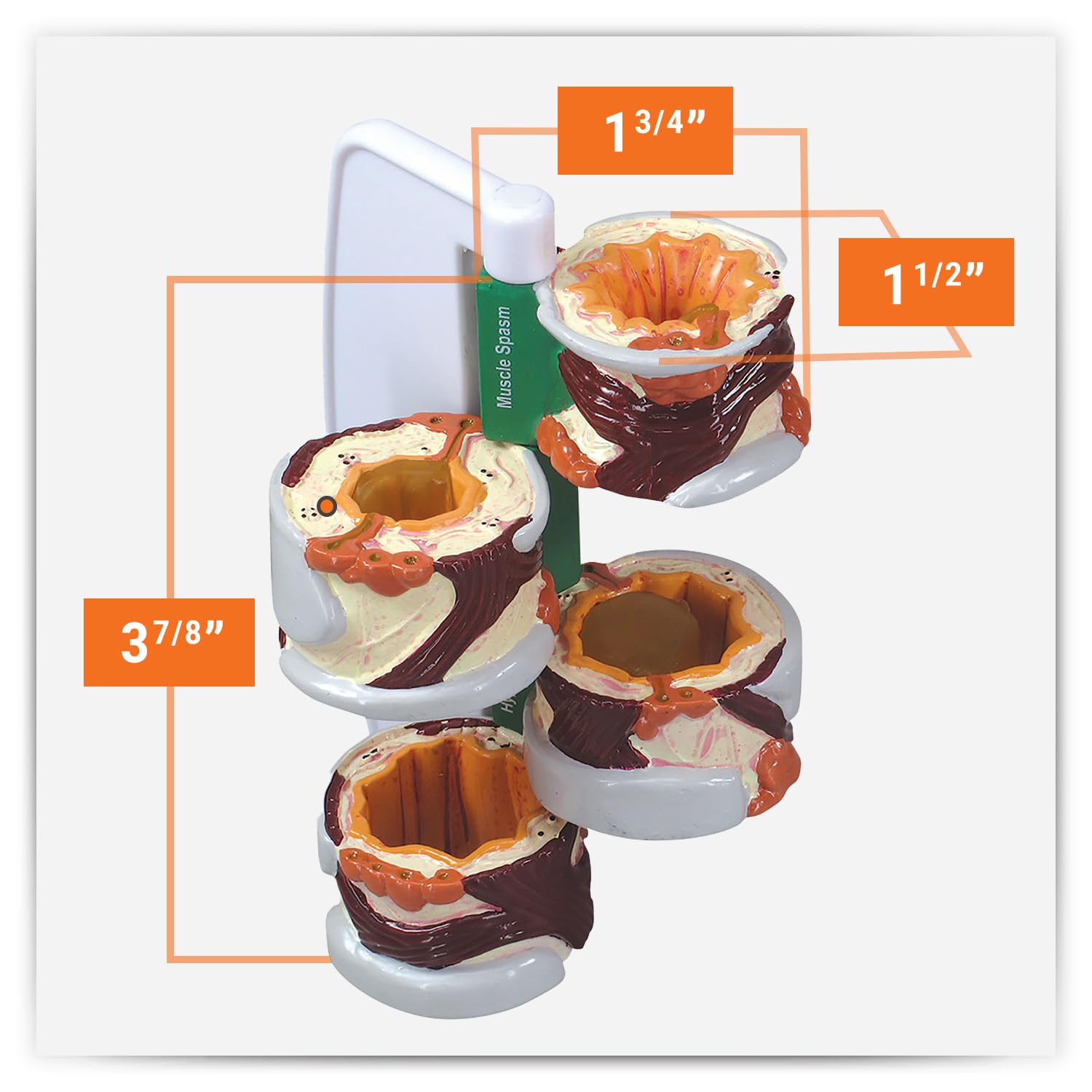 GPI Anatomicals - 4-Piece Bronchus Model, Replica of a Bronchus with Pathologies for Human Anatomy, Physiology Education, Anatomy Model for Doctor's Offices and Classrooms, Medical Learning Resources