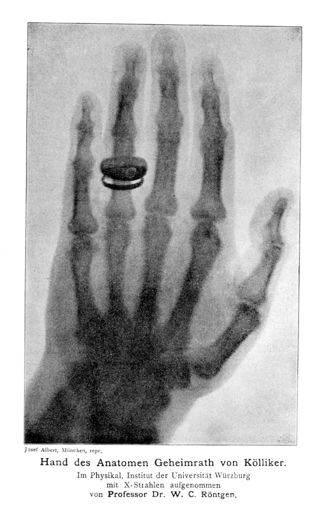Amazon.co.jp: W Roentgen X-Ray 1896 Nthe First Published X線