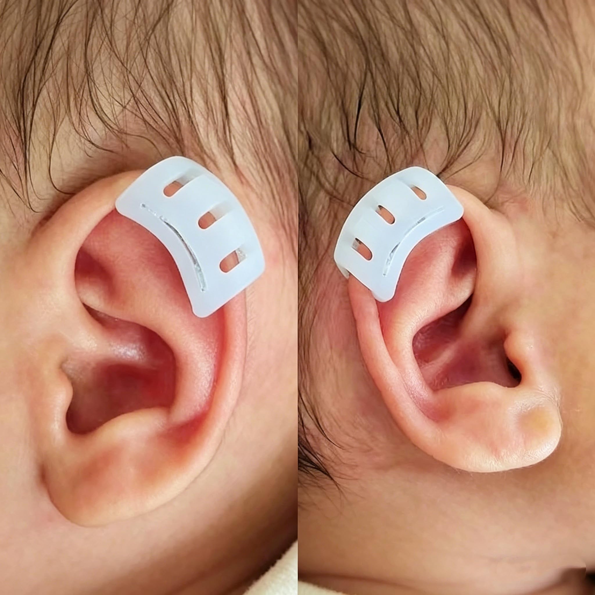 Infant Lop Ear Deformity Correction Clip For Newborn Baby Fixing Auricle Valgus Patch Stickers Children Ear Shape Aesthetic Corrector Without Surgery product thumbnail 3