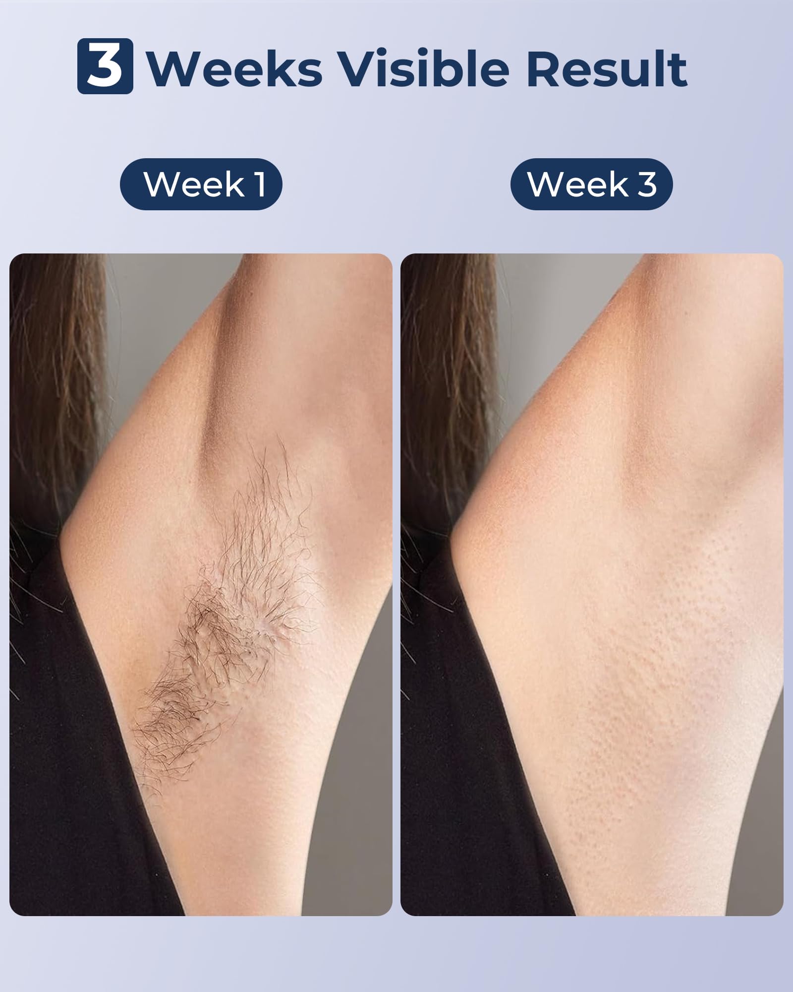Depilación láser IPL para mujeres y hombres, zafiro, enfriamiento de hielo, sin dolor, resultado duradero, dispositivo de depilación en casa para piernas, cara 5