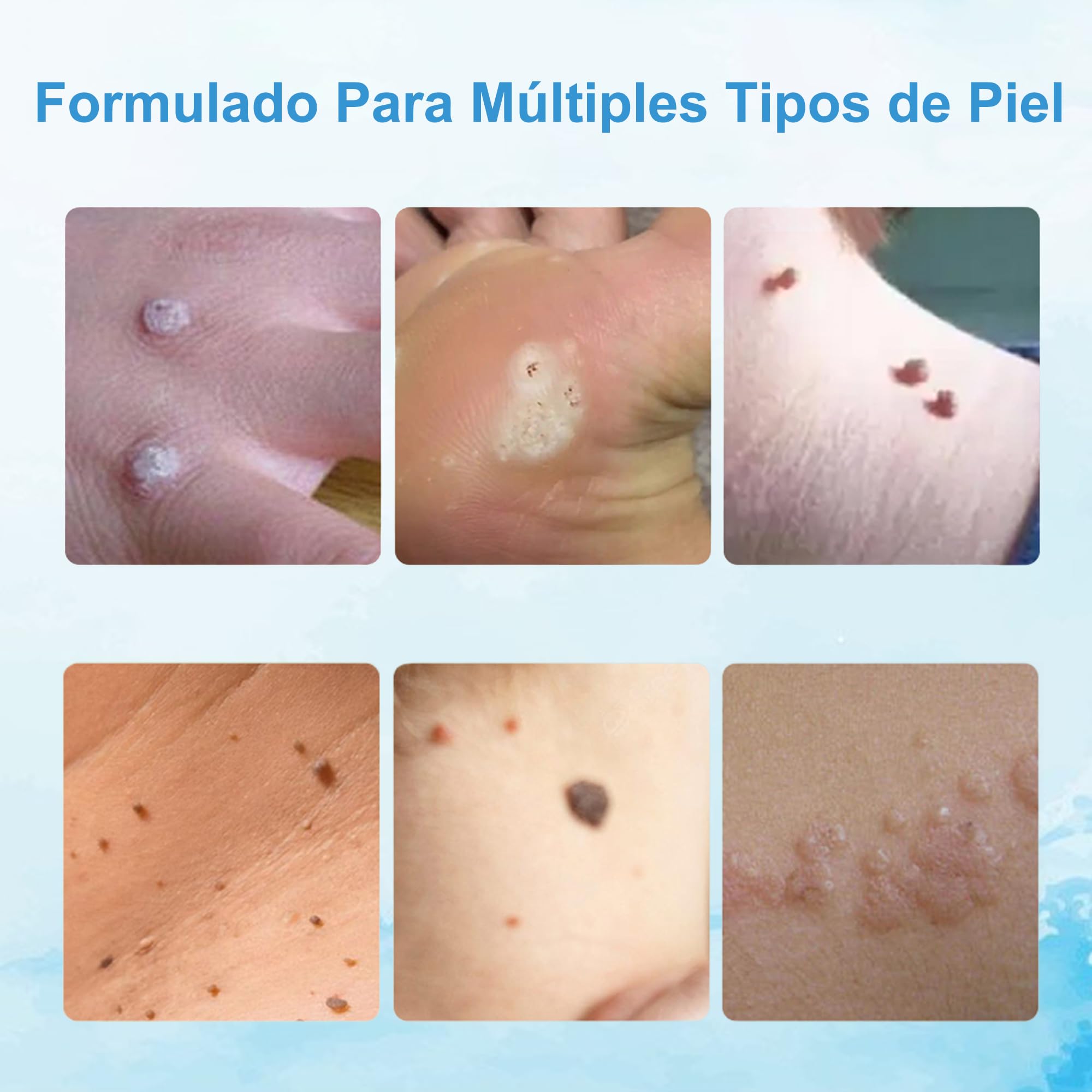 Crema para eliminar verrugas y acrocordones, kit para rostro y cuerpo, eliminación suave de verrugas plantares, comunes, callos y planas, 20 g - 3