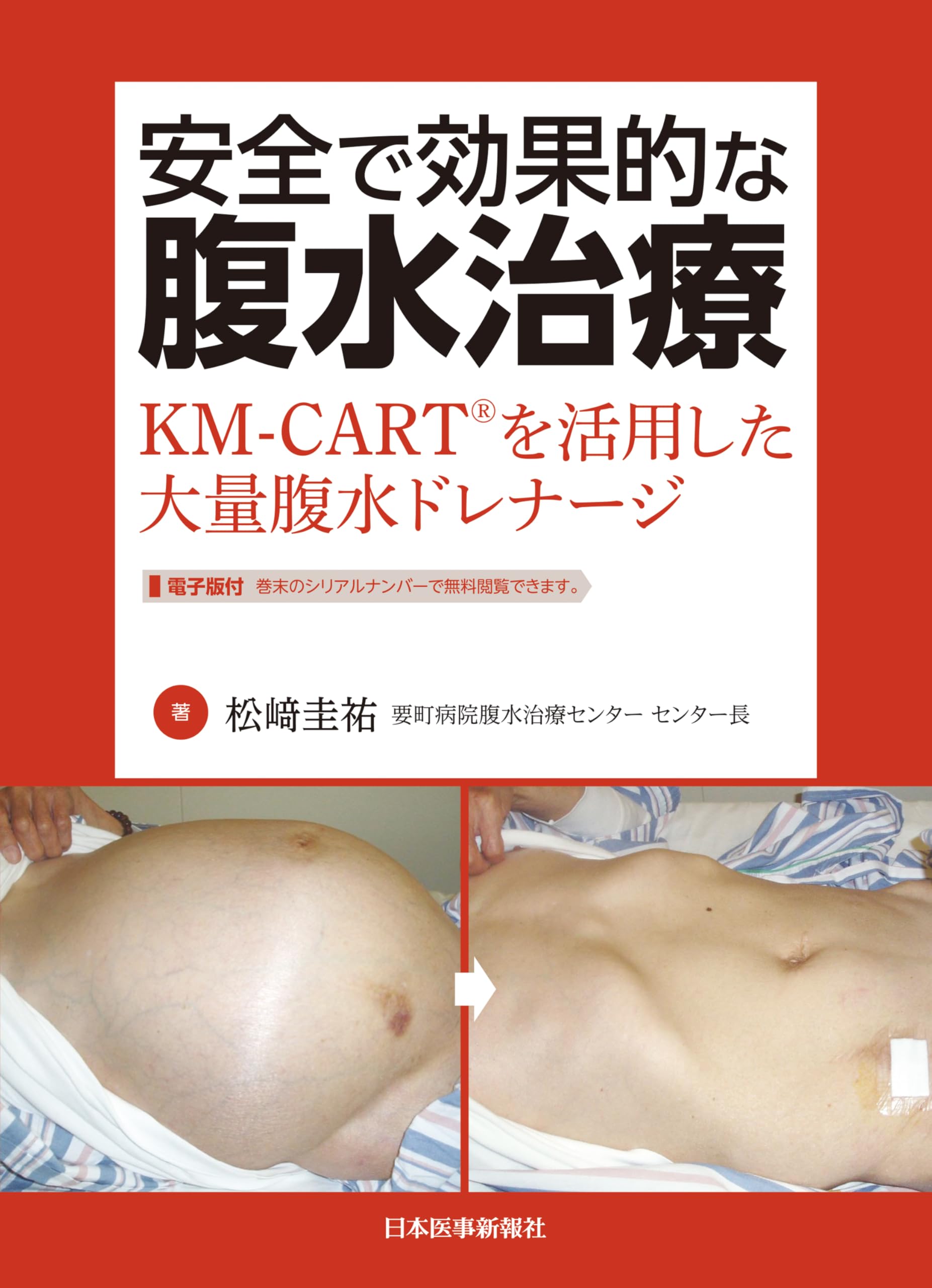 安全で効果的な腹水治療 KM-CARTを活用した大量腹水ドレナージ | 松﨑