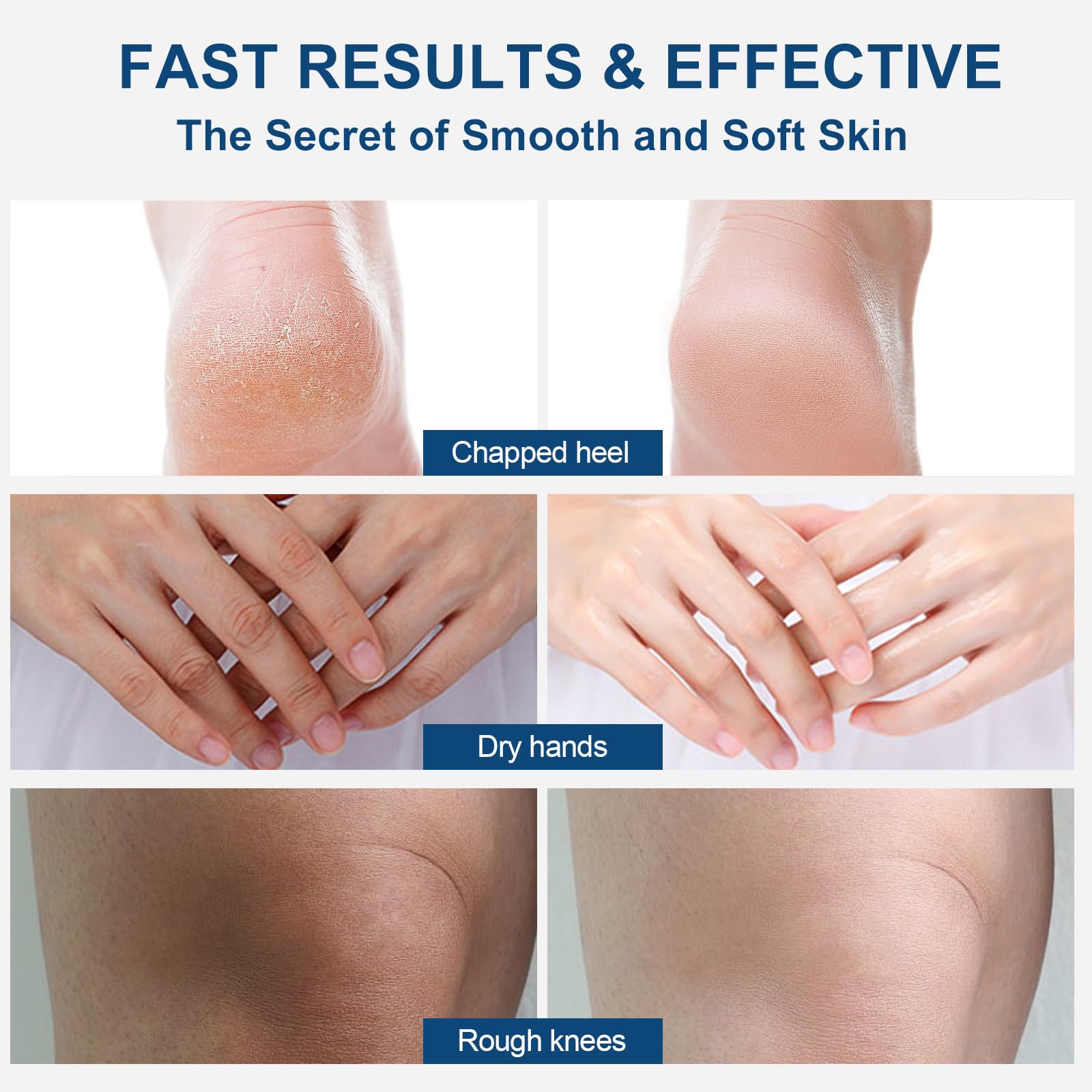 Crema Piedi Urea 40%,150g,Crema Piedi Secchi Screpolati,Cream Foot Urea,Trattamento Per Talloni Screpolati,Ammorbidimento Dei Calli E Cura,Per Foot,Mani,Talloni,Gomiti,Unghie E Ginocchia