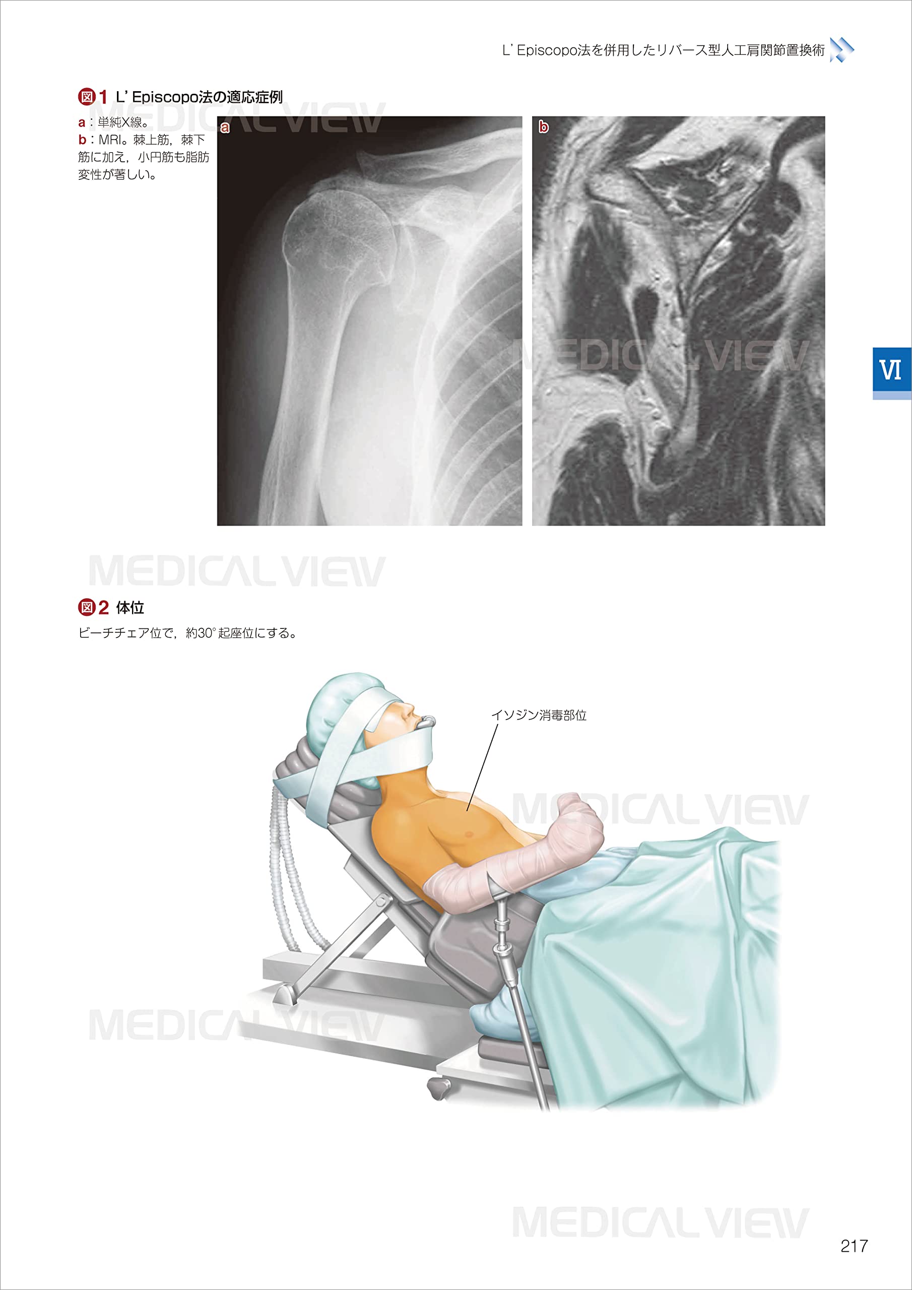 肘関節手術のすべて メジカルビュー社｜整形外科｜肘関節手術のすべて