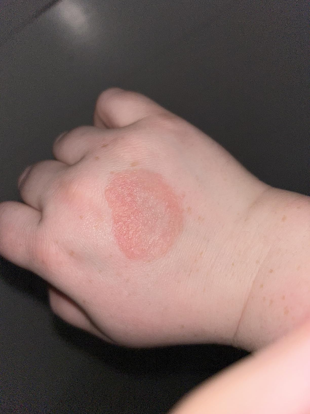 Before — eczema on hand