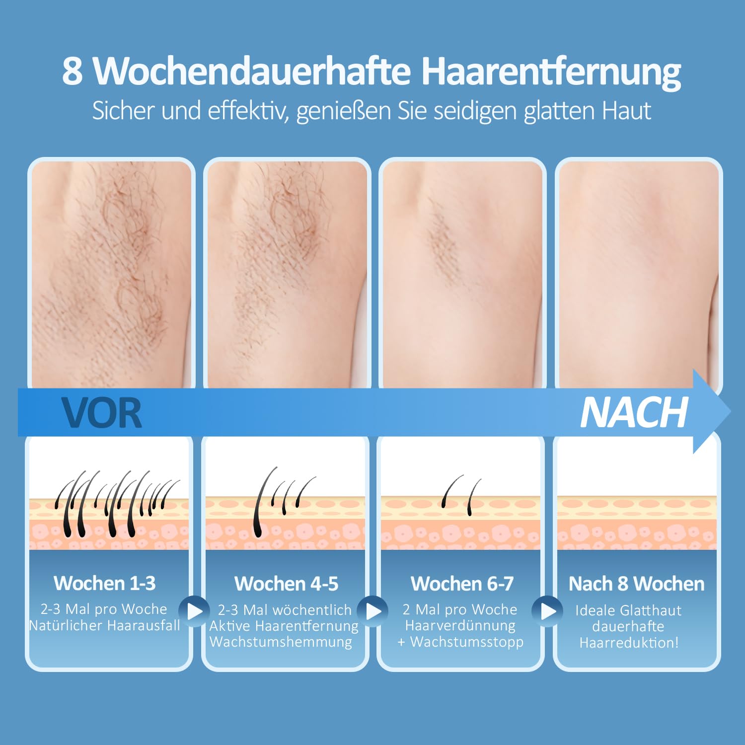 IPL Geräte Haarentfernung mit Kühlfunktion – Laser Haarentfernung 5 Energiestufen 999.999 Lichtimpulse Dauerhafte Haarentfernungsgerät