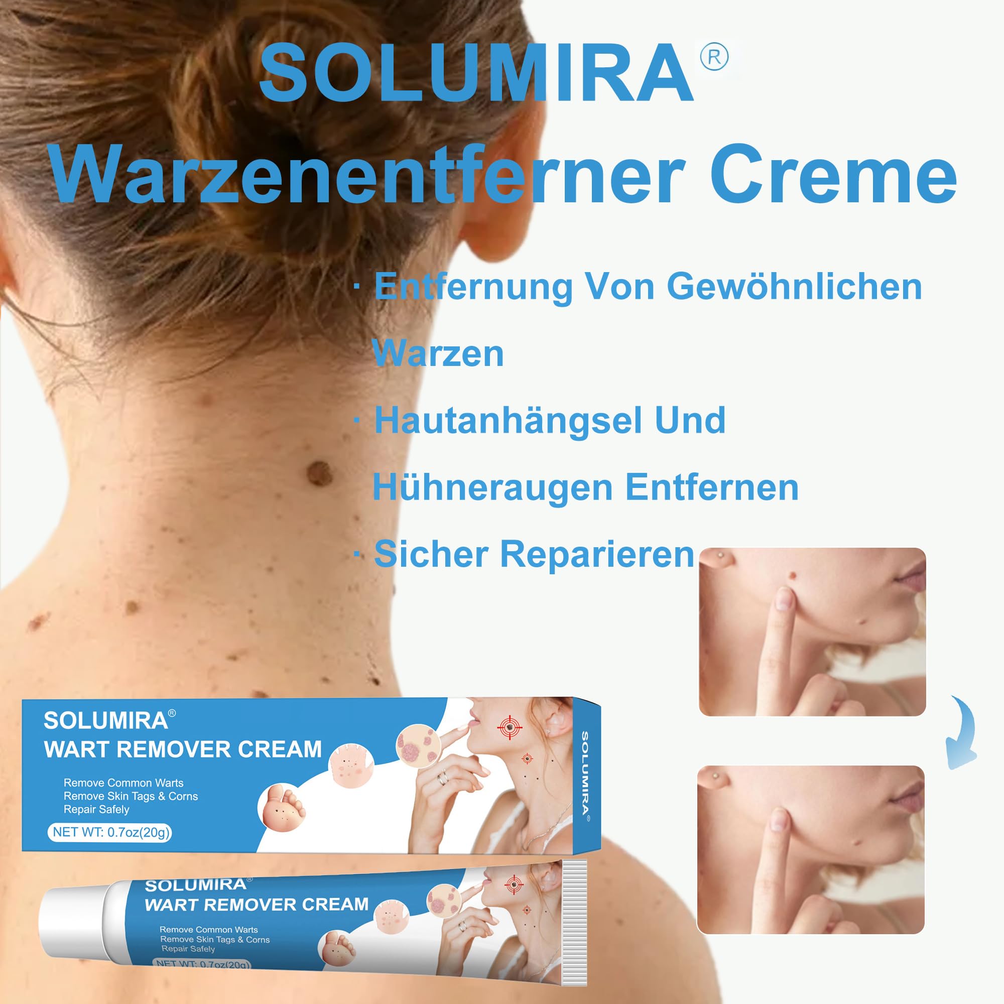Warzenentfernungscreme für Gesicht und Körper - 20g