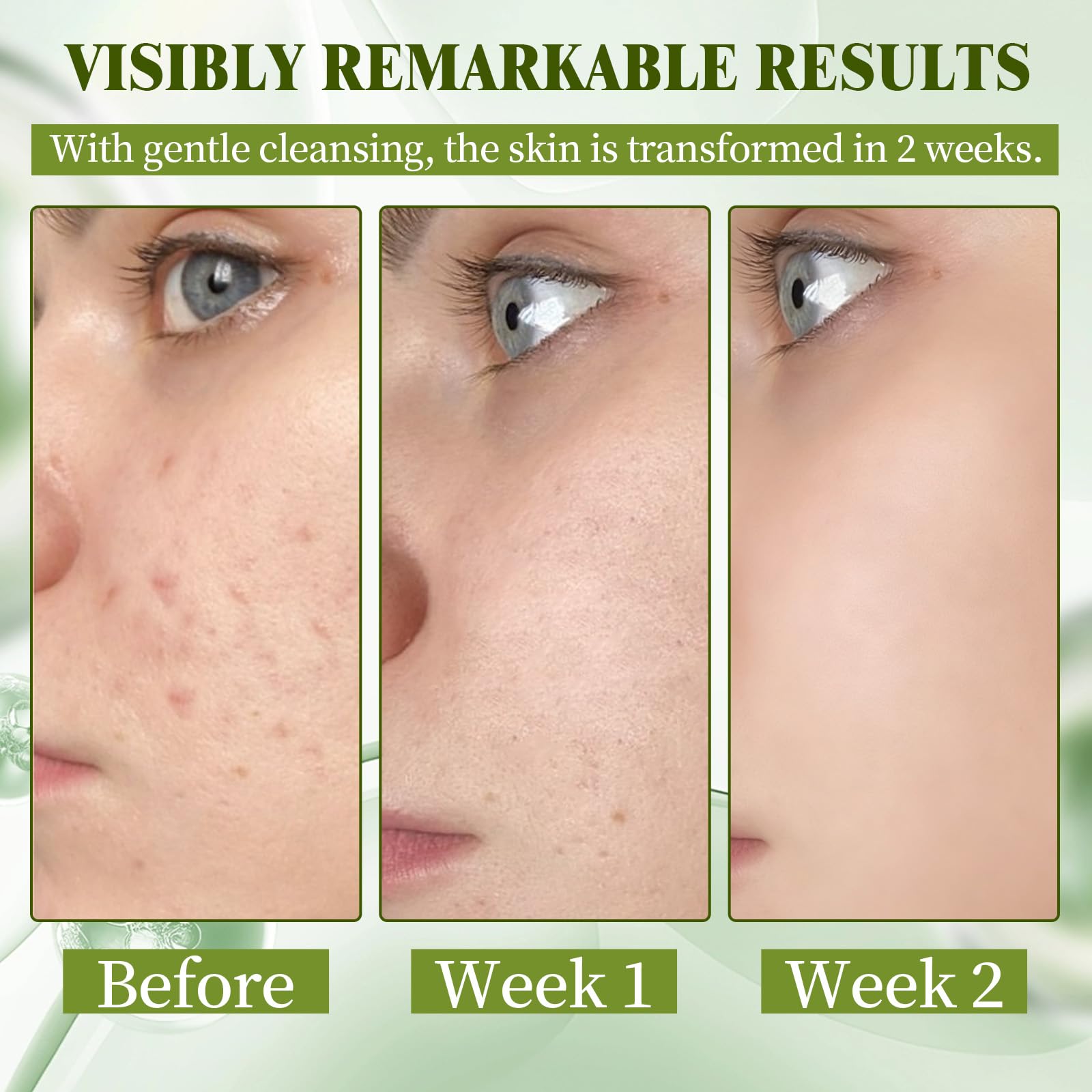Crema Brufoli Viso, Crema Acne Potentissima, Combatte Efficacemente Acne, Brufoli e Punti Neri, Lenisce Rapidamente Gli Arrossamenti Cutanei, Adatto a Tutti i Tipi di Pelle, Ingredienti Delicati
