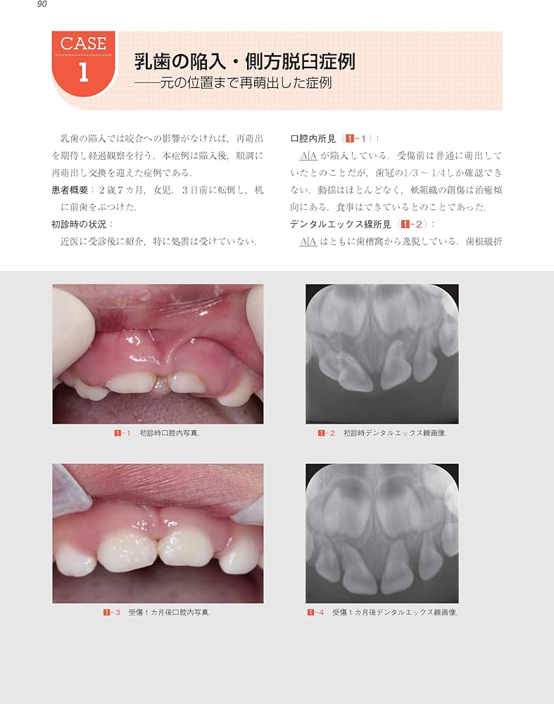これで安心！ 乳歯・幼弱永久歯の外傷への対応―保存か抜歯かを見極め
