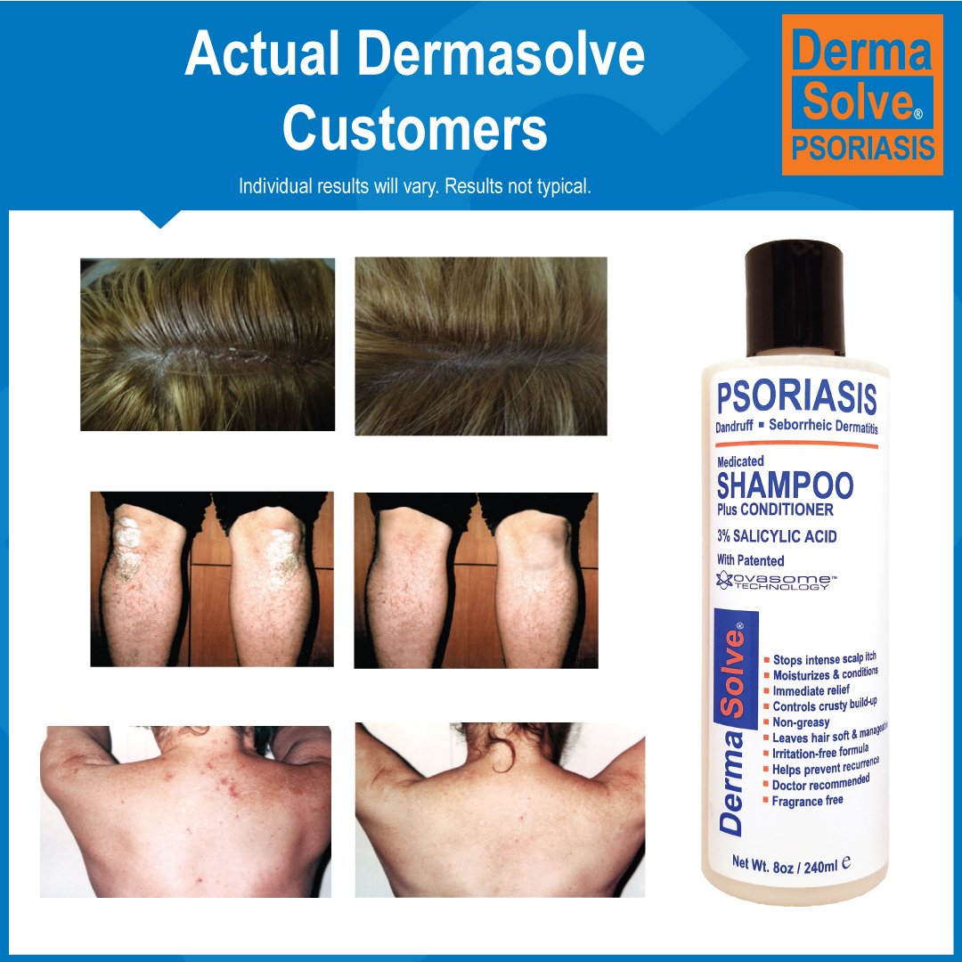 Scalp Psoriasis Shampoo & Conditioner (2pack) Naturally Heals Dandruff