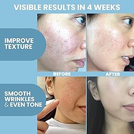 Collagen Peptide Serum for Face - Anti Aging Facial Treatment with Peptides & Hyaluronic Acid - Gentle Formula for Sensitive Skin, Microneedling Pen, Derma Roller, Skin Firming & Hydrating (1 Oz)