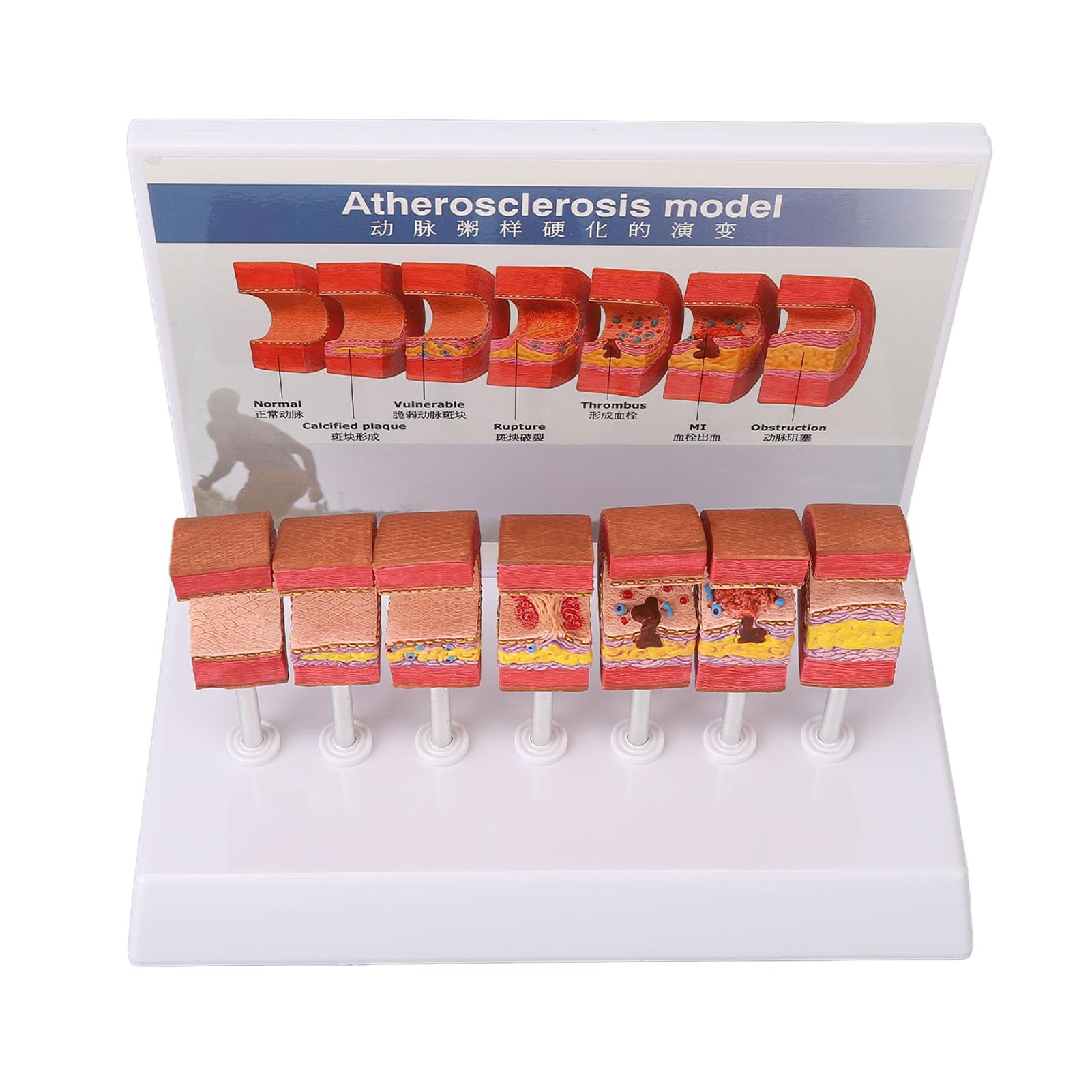 Anatomy Replica Model, Atherosclerosis Human Body Artery Model Bright Colors Simulation Ecofriendly PVC for Educational Tool