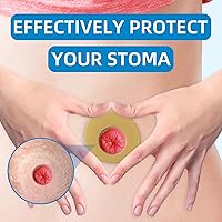 Vista 7 de 10 anillos de barrera para ostomía, anillos de ostomía moldeables sin picaduras, anillos extensores hidrocoloides para bolsas de colostomía