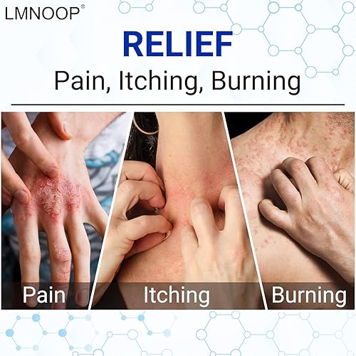 Miniatura 10 de Crema para eccema para piel seca, picazón, irritada y propensa al eccema, ungüento de tratamiento de máxima fuerza para erupciones, psoriasis,