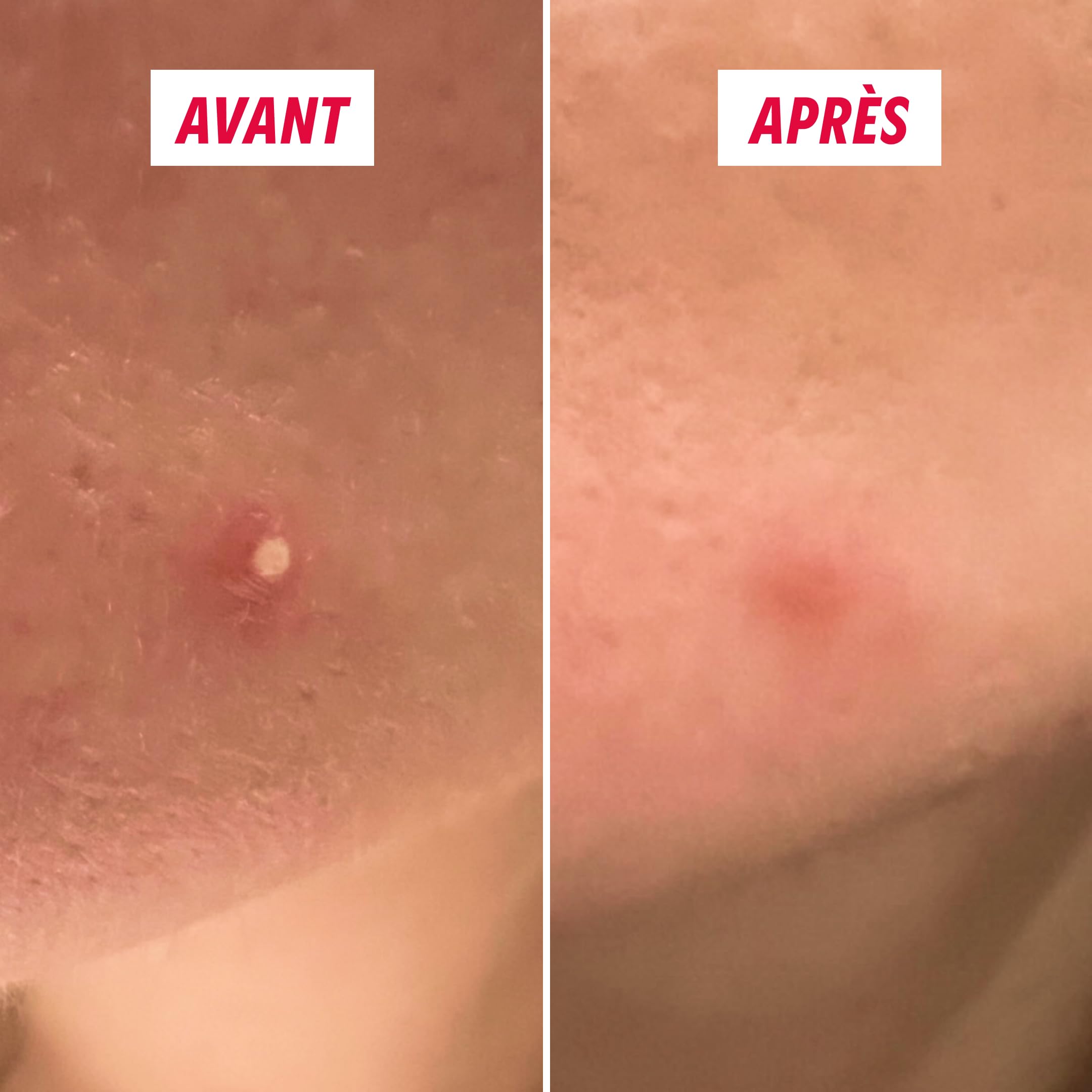 Patch Bouton My SOS Beauty - Pack de 36 Patchs - Patch Hydrocolloïde - Absorbe le Sébum et Réduit les Boutons en 8H - Résultats dès la Première Nuit - Boutons Blancs - Invisible et Fin