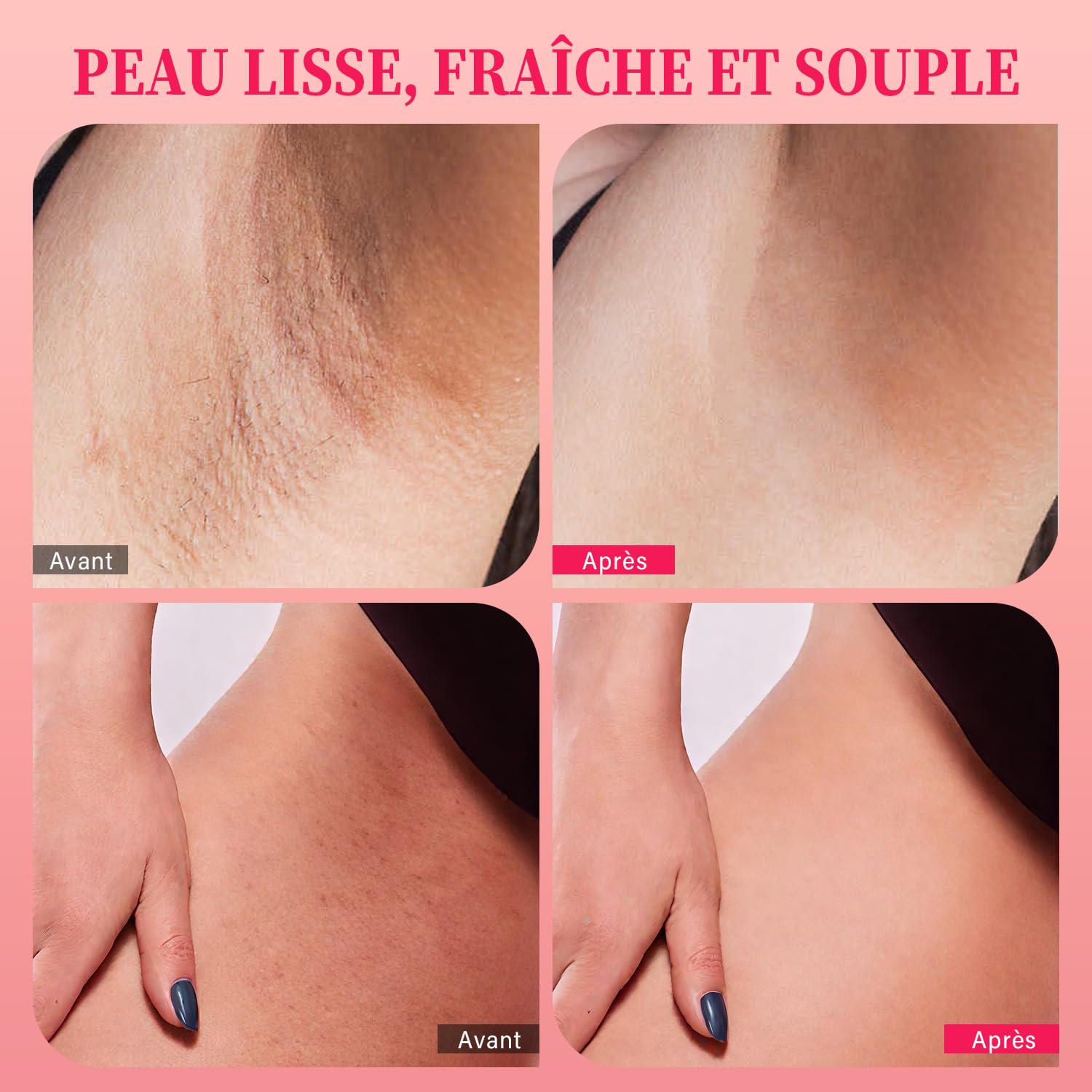 Gommage exfoliant pour le maillot avec 10% AHA + BHA et vitamine C, exfoliant pour le corps, élimine les poils incarnés, les boutons sous les aisselles, les taches brunes et unifie le teint, 200g