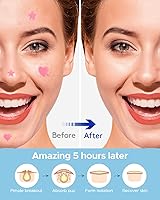 Vista 7 de LitBear Parche para acné, parche para espinillas, corazón rosa y estrella para absorber el acné, parches hidrocoloides para acné, parches de acné