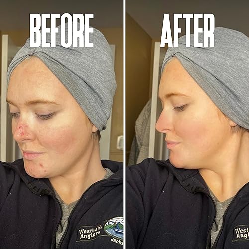 Miniatura 9 de Ahorra un 30 % en el juego de almohadillas de rejuvenecimiento glicólico con ácido glicólico con 40 % y almohadillas de rejuvenecimiento glicólico: