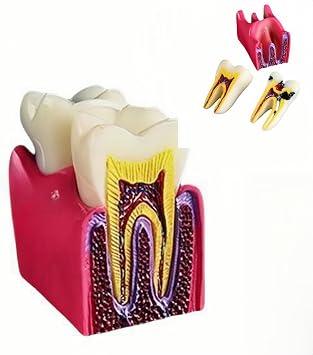 6 Times Dental Caries Model Teaching Typodont Tool for Dentists, Patients, Teachers and Students Studying and Researching Teeth Removal