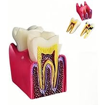 6 Times Dental Caries Model Teaching Typodont Tool for Dentists, Patients, Teachers and Students Studying and Researching Teeth Removal