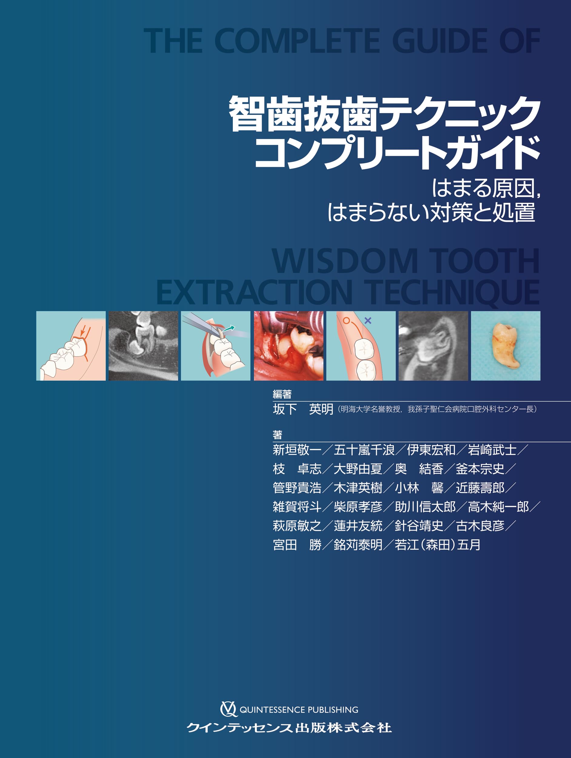 智歯抜歯テクニックコンプリートガイド: はまる原因、はまらない対策と