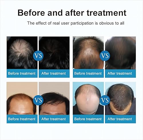 Miniatura 3 de Red Light Therapy for Hair GrowthFDA Cleared Hair Regrowth Devices(204pcs Medical Grade Lasers, Not LED)APP Control Laser Cap for Hair RegrowthHair