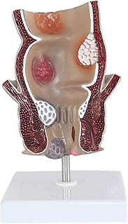 Study Model Magnify 1.5 Times Rectal Pathology Model - Human Organ Anatomy Mode Acne Anorectal Rectal Disease Demonstration Model - for Medical Educational Training Aid SaiFei