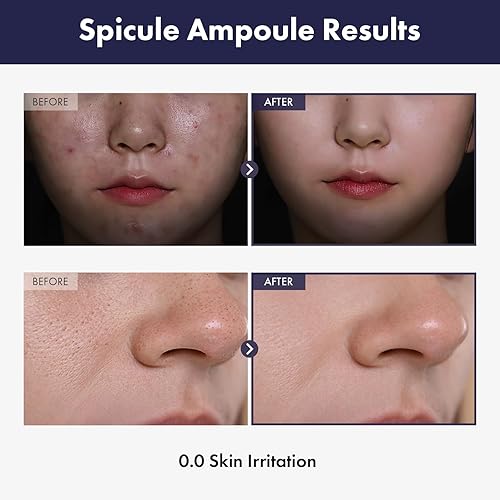 Miniatura 2 de TOSOWOONG Ampolla real Spicule con 30,000 inyecciones, niacinamida, pantenol, suero líquido potenciador de la piel, minimizador de poros,